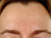 Multipele miliaire osteomen