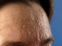 Multipele miliaire osteomen