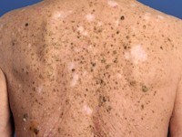 Leser-Trélat syndroom