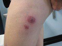 Mycobacterium chelonae