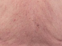 Mycosis fungoides in dennenboom configuratie