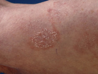 Mycosis fungoides, eczemateuze stadium