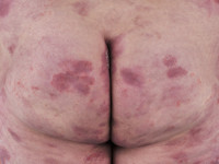 Mycosis fungoides, eczemateuze stadium