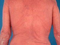 Mycosis fungoides, erytrodermie