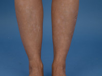 Mycosis fungoides, gehypopigmenteerd