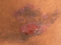 Mycosis fungoides, plaques stadium