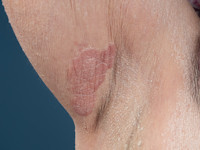 Mycosis fungoides, plaques stadium