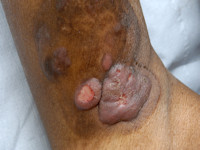 Mycosis fungoides, tumor stadium