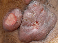 Mycosis fungoides, tumor stadium