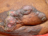 Mycosis fungoides, tumor stadium