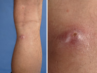 Human botfly, dermatobia hominis larve