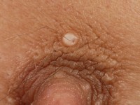 Myxoma cutis bij Carney complex