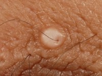 Myxoma cutis bij Carney complex