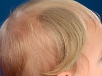 Naevoide hypertrichosis