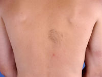 Naevoide hypertrichosis