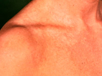 Naevus anemicus, anemic nevus