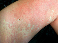 Naevus anemicus, anemic nevus