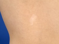 Naevus depigmentosus