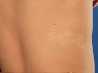 Naevus depigmentosus