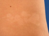 Naevus depigmentosus