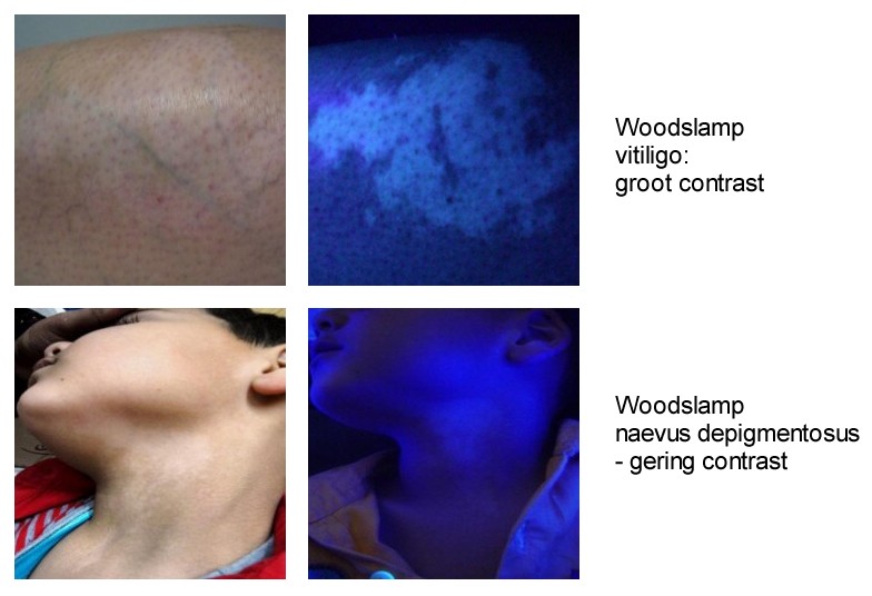 Woodslamp onderzoek naevus depigmentosus