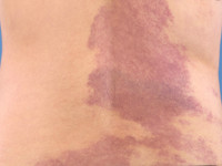 Phakomatosis cesioflammea