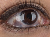 Phakomatosis cesioflammea