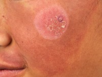 Eczeem in naevus flammeus (Meyerson fenomeen)