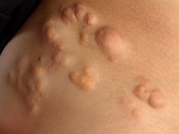 Naevus lipomatosus cutaneous superficialis