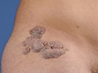 Naevus lipomatosus cutaneous superficialis