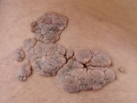 Naevus lipomatosus in fasen verwijderd met elektrocoagulatie