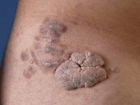 Naevus lipomatosus in fasen verwijderd met elektrocoagulatie