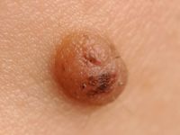 Molluscoide naevocytaire naevus