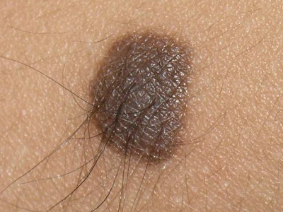 Naevus naevocellularis (mole)