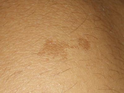 Naevus naevocellularis (moedervlek)