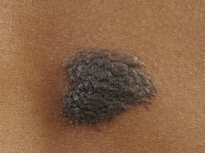 naevus naevocellularis