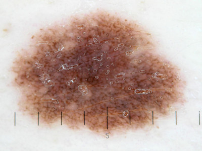 Naevus naevocellularis (moedervlek)