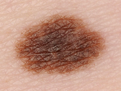 Naevus naevocellularis (moedervlek)