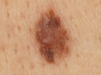 Opruimreactie in naevus naevocellularis