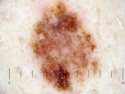 Opruimreactie in naevus naevocellularis