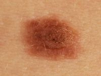 Naevus naevocellularis papillomatosus