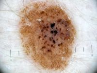 Naevus naevocellularis papillomatosus