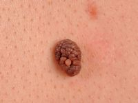 Naevus naevocellularis papillomatosus