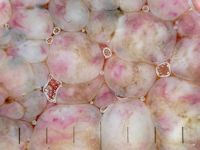 Naevus naevocellularis papillomatosus