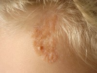 Nevus sebaceus