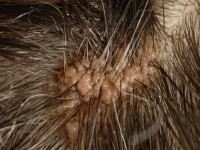 Nevus sebaceus