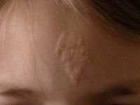 Nevus sebaceus