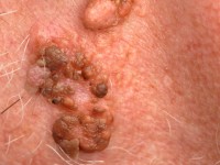 Nevus sebaceus