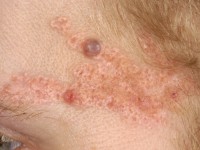 Basal cell carcinoma arising from a nevus sebaceus
