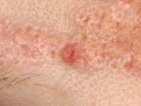 Basal cell carcinoma arising from a nevus sebaceus